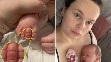 My baby’s toe was nearly amputated — doctors said a strand of hair was the problem