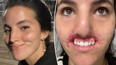 My entire top lip was ripped off by a Pitbull — here's what I've learned about beauty