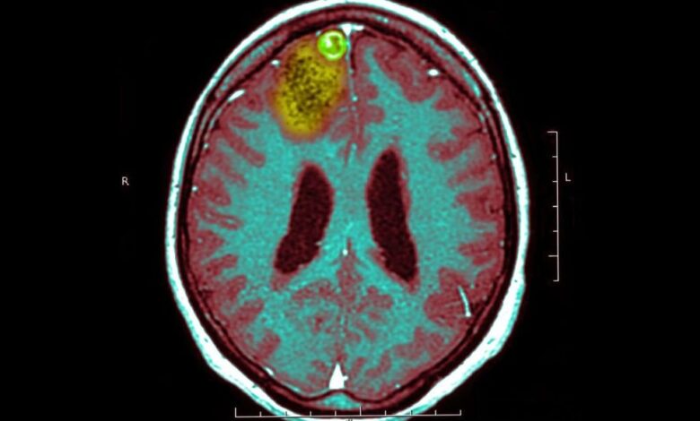 Doctor tries experimental cancer treatment to cure glioblastoma from a brain tumor