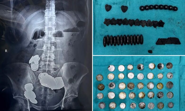 Indian man ate 39 coins, 37 magnets because he thought 'zinc helps in bodybuilding'
