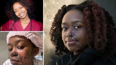 Woman burned by acid in random subway attack has 16th surgery to to fix face