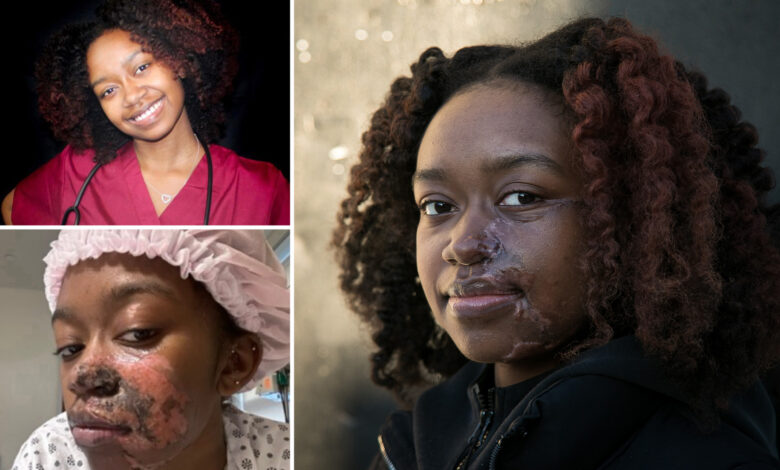 Woman burned by acid in random subway attack has 16th surgery to to fix face