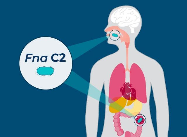 Researchers say that a subtype of Fusbacterium nucleatum, which is found in the mouth, may help colorectal cancers develop and grow.