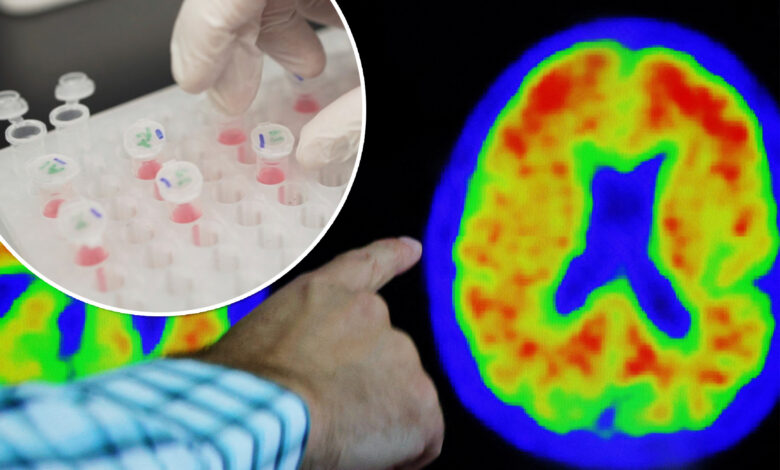 Accuracy of blood tests for Alzheimer’s disease varies: study