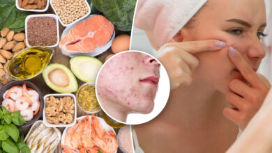 Omega-3 algae supplements may help ease acne: study