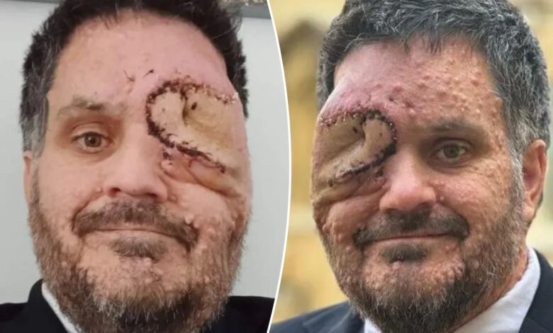 Man with facial disfigurement asked to leave restaurant for 'scaring customers'