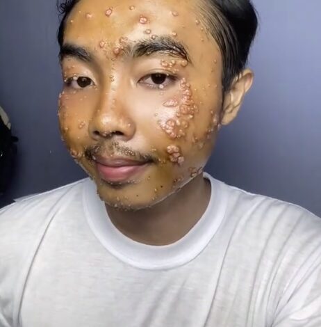 Man got skin condition from thrifted clothes