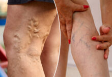 Varicose veins and spider veins are different — how to prevent them