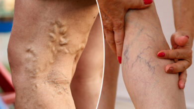 Varicose veins and spider veins are different — how to prevent them