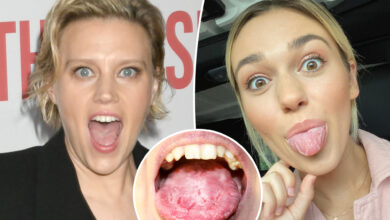 What is 'geographic tongue'? All about 'SNL' star Kate McKinnon's 'gross' condition