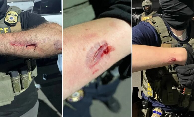 Immigration agents display bloody wounds with bite marks
